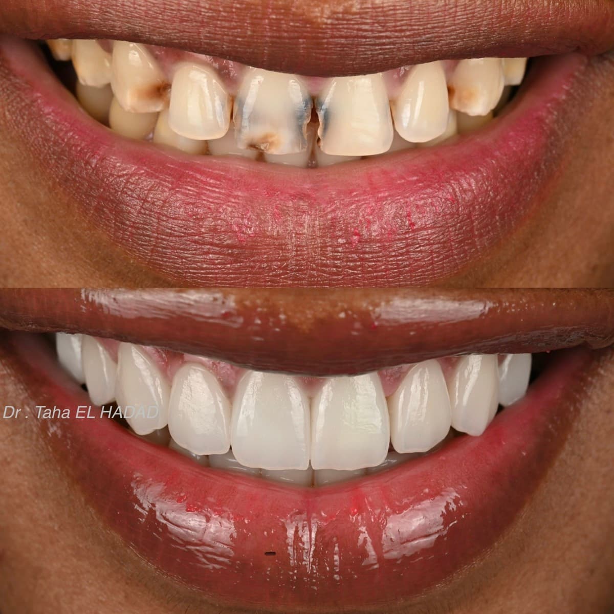 Blanchiment dentaire avant et apres, resultat professionnel realise a Casablanca par Master Smile Clinic