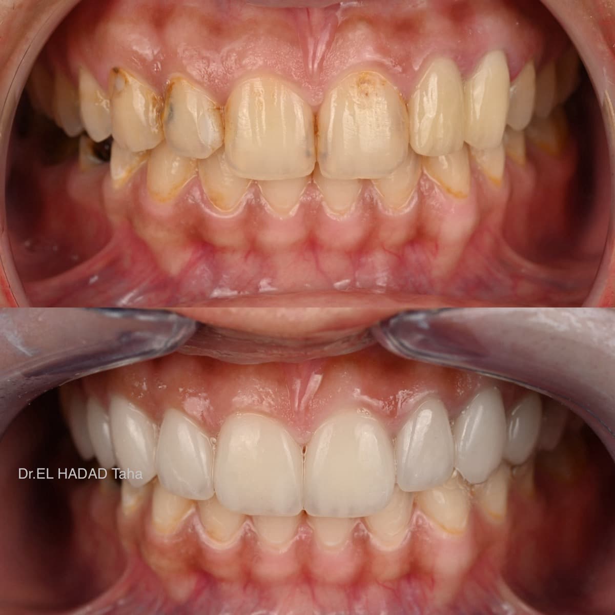 Resultat blanchiment dentaire professionnel avant et apres a Casablanca par Dr. Taha El Hadad