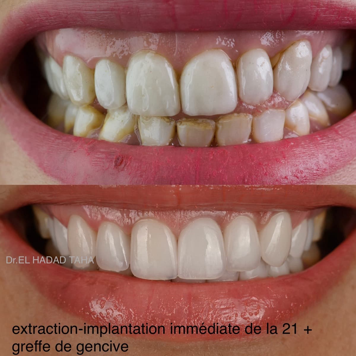 Blanchiment des dents avant et apres, traitement en clinique dentaire a Casablanca