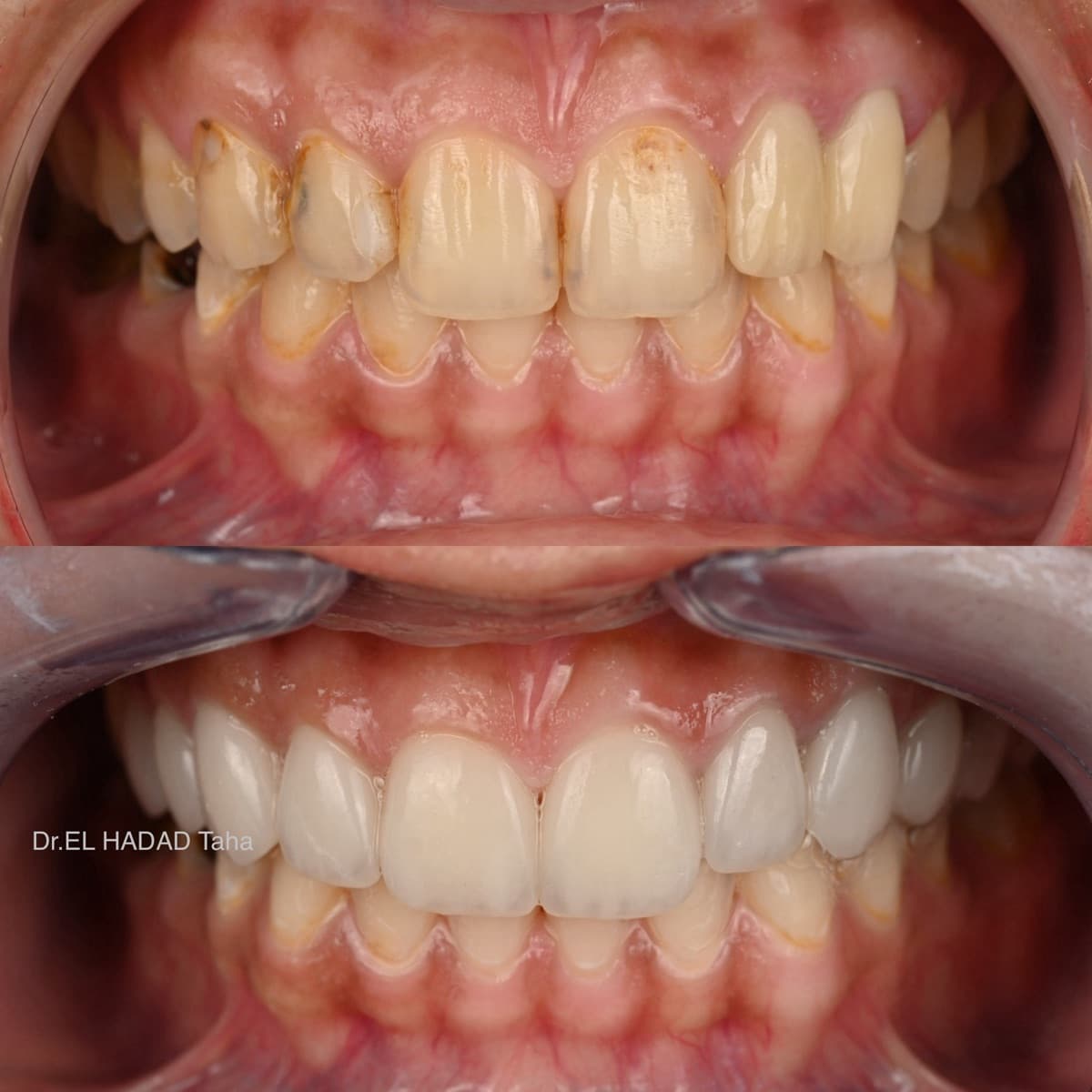 Soigner une carie à Casablanca : avant après traitement des caries et anciennes obturations, Master Smile Clinic