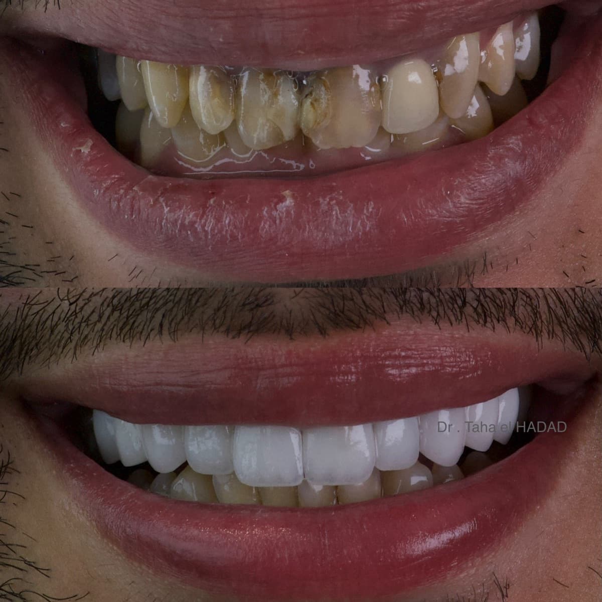 Dents abîmées et cariées réhabilitées à Casablanca : avant après au Master Smile Clinic par le Dr Taha El Hadad