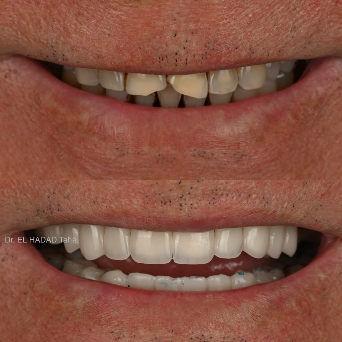 Dent cassée réparée à Casablanca : avant après restauration esthétique chez l’homme, Master Smile Clinic