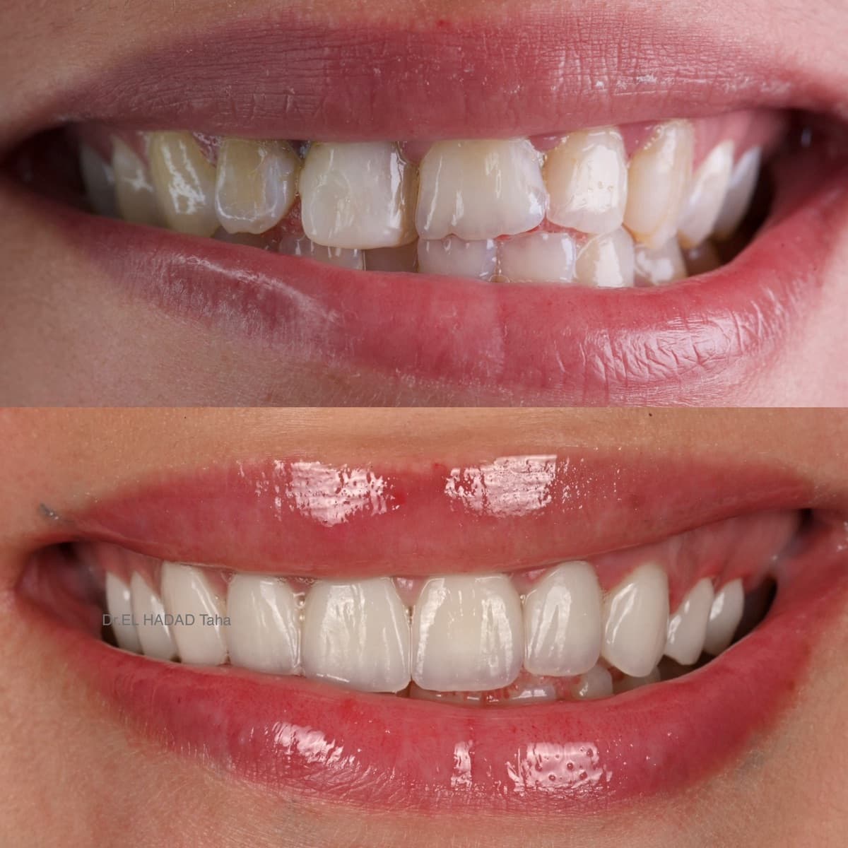 Dent grise dévitalisée traitée à Casablanca : avant après esthétique dentaire, Master Smile Clinic