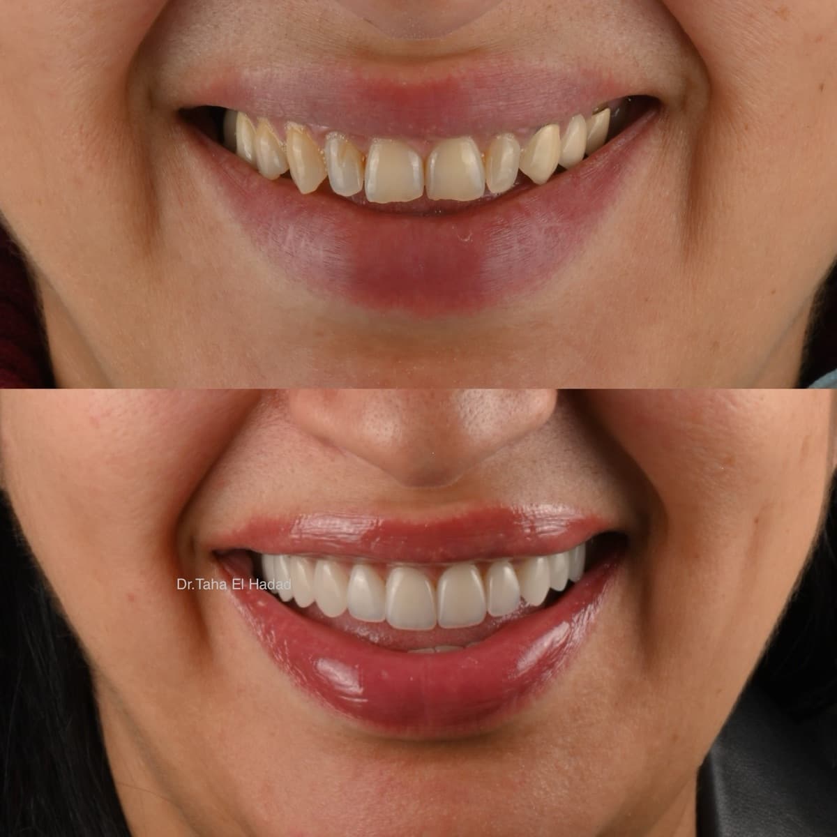 Dents trop petites corrigées à Casablanca : avant après facettes dentaires chez la femme, Master Smile Clinic