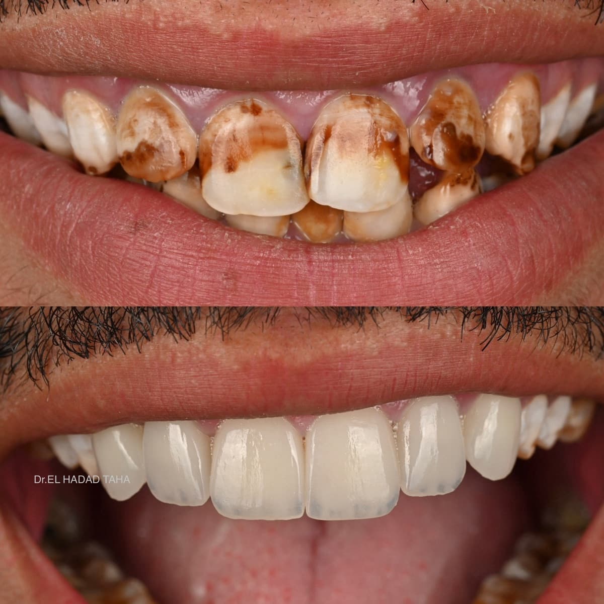 Dents tachées marron traitées à Casablanca : résultat avant après esthétique dentaire, Dr Taha El Hadad