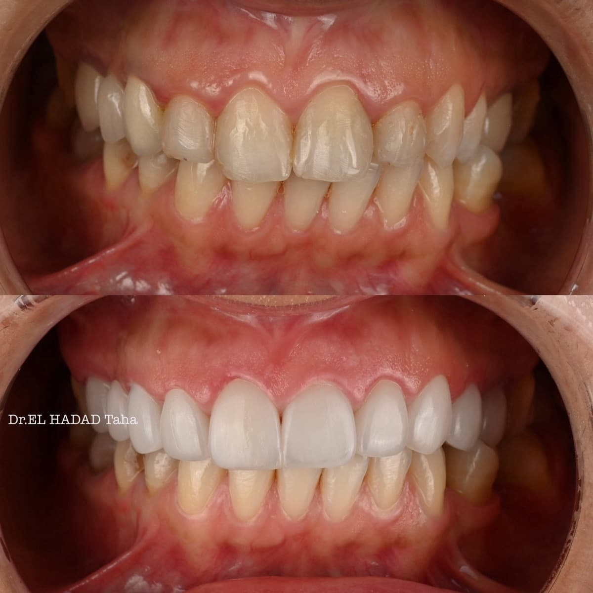 Facettes céramique à Casablanca vues de près : avant après sur dents jaunies, Master Smile Clinic