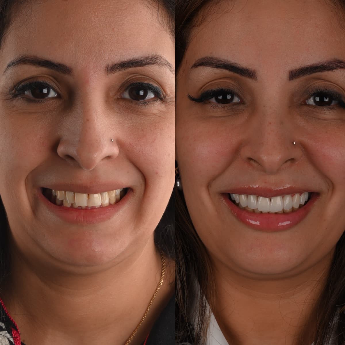 Facettes dentaires à Casablanca avant après : dents jaunies et usées transformées en sourire naturel par le Dr Taha El Hadad