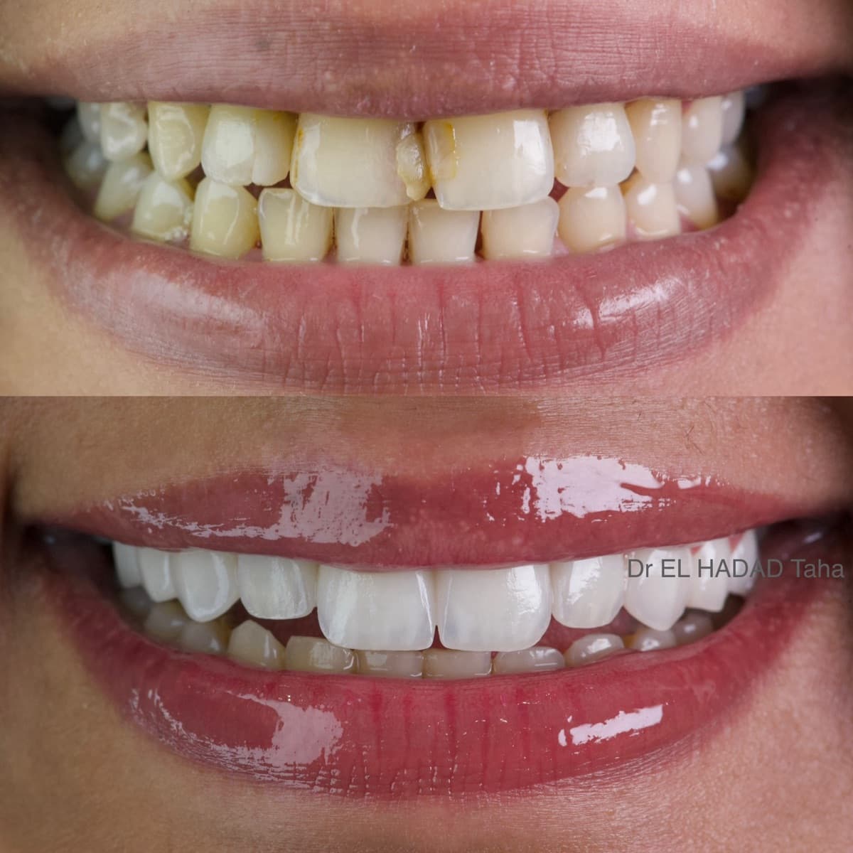 Dents mal alignées corrigées à Casablanca sans bagues : avant après facettes dentaires, Dr Taha El Hadad