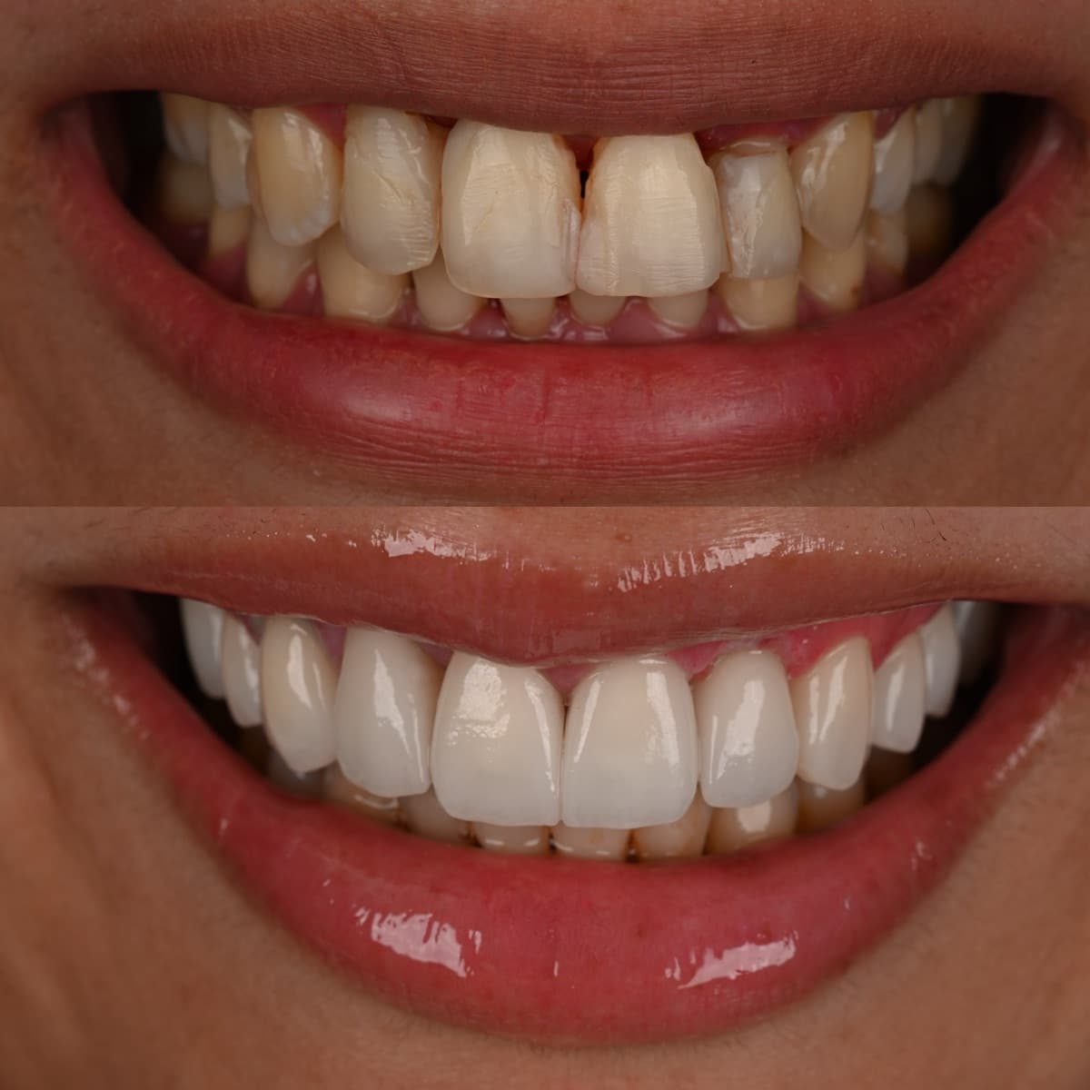 Fermer un espace entre les dents à Casablanca : avant après facettes dentaires sur dents usées, Master Smile Clinic