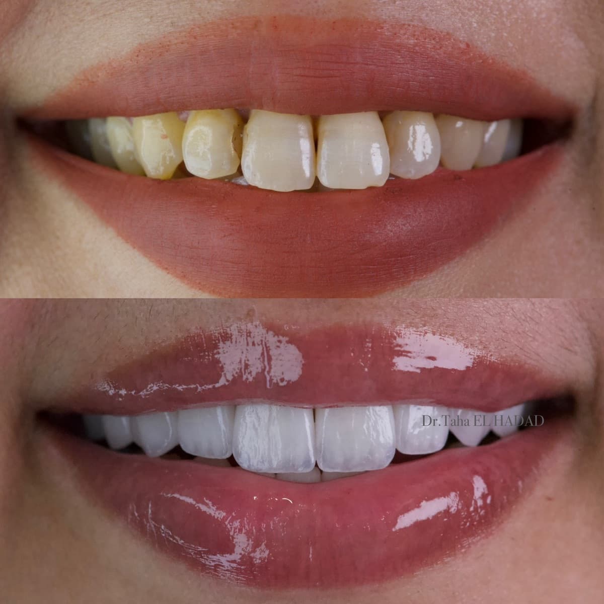 Hollywood Smile à Casablanca chez la femme : avant après facettes dentaires, Master Smile Clinic