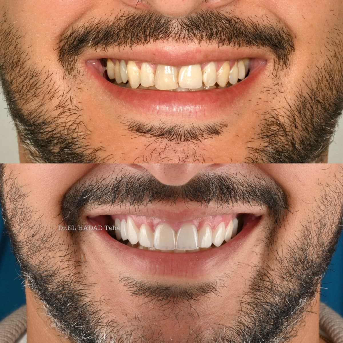 Hollywood Smile à Casablanca chez l’homme : avant après facettes dentaires, Dr Taha El Hadad