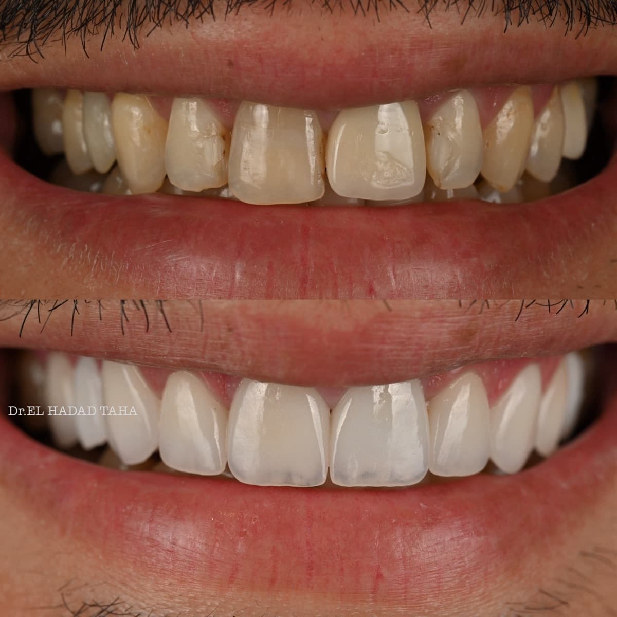 Refaire d’anciennes facettes et couronnes à Casablanca : avant après esthétique dentaire, Master Smile Clinic