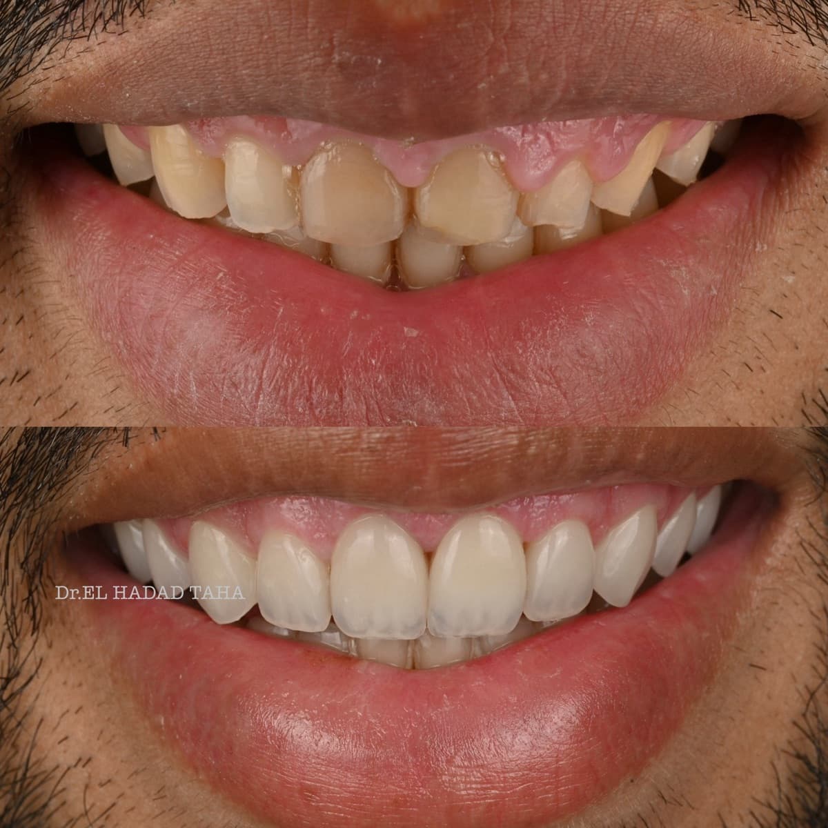 Sourire gingival corrigé à Casablanca : avant après harmonisation de la gencive et des dents, Master Smile Clinic