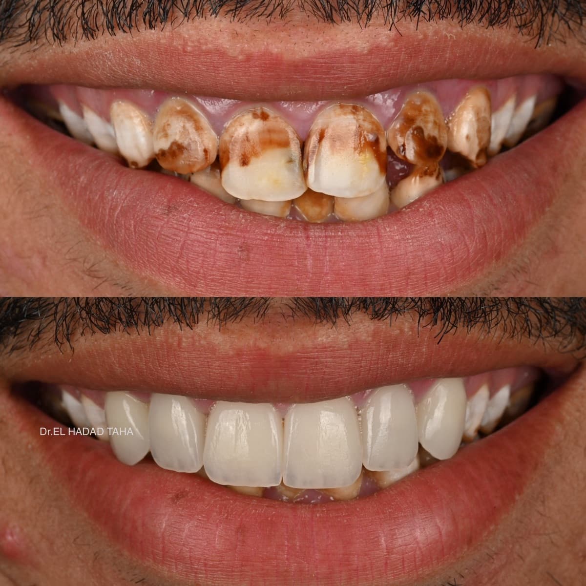 Taches brunes sur les dents à Casablanca : avant après traitement esthétique dentaire au Master Smile Clinic