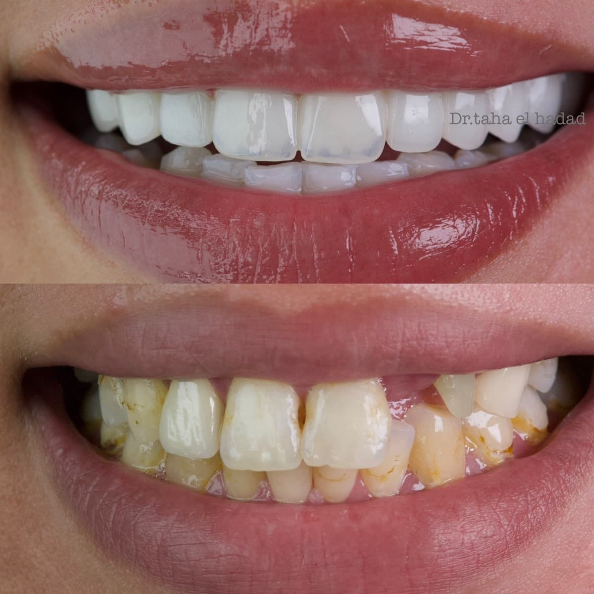 Détartrage et traitement des colorations à Casablanca : avant après, Master Smile Clinic