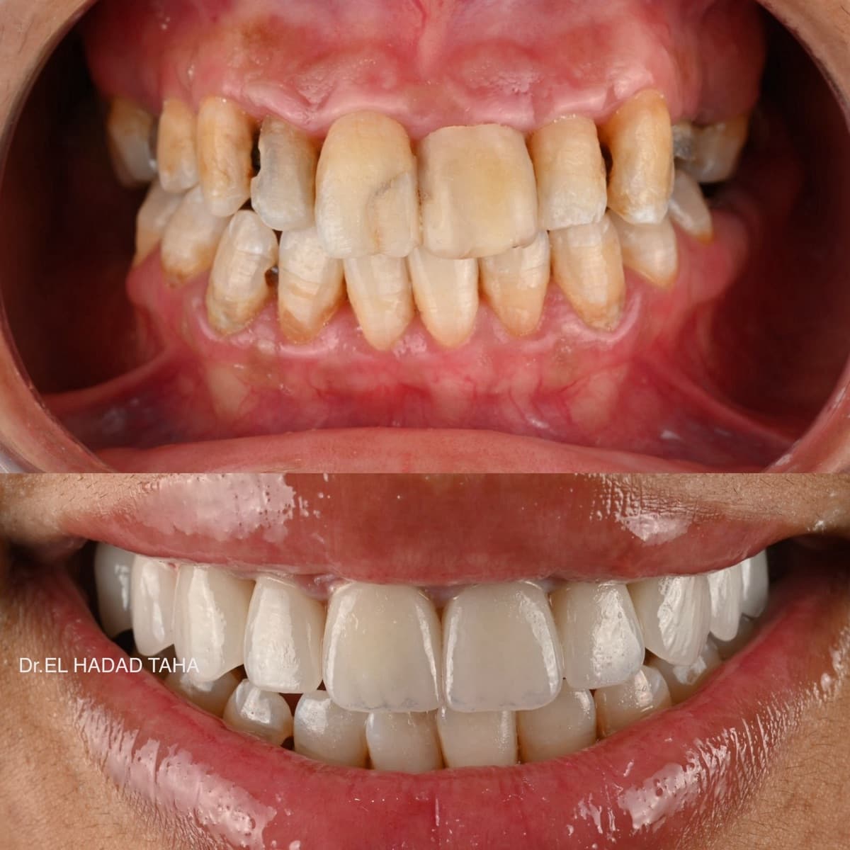 Dents usées par le bruxisme réhabilitées à Casablanca : avant après, Master Smile Clinic