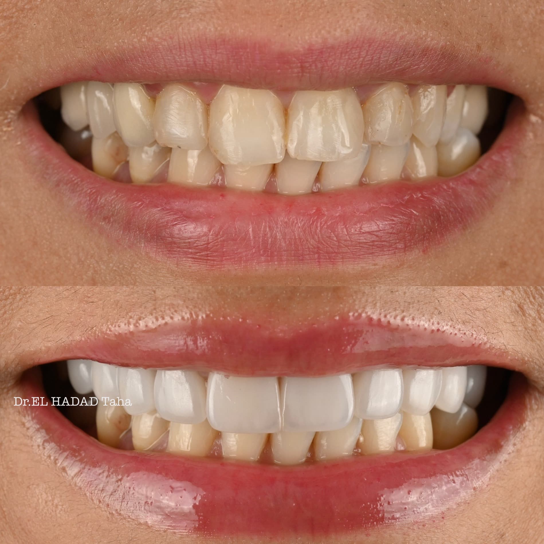 Intervention chirurgie dentaire resultat avant apres a la clinique Master Smile Clinic Casablanca