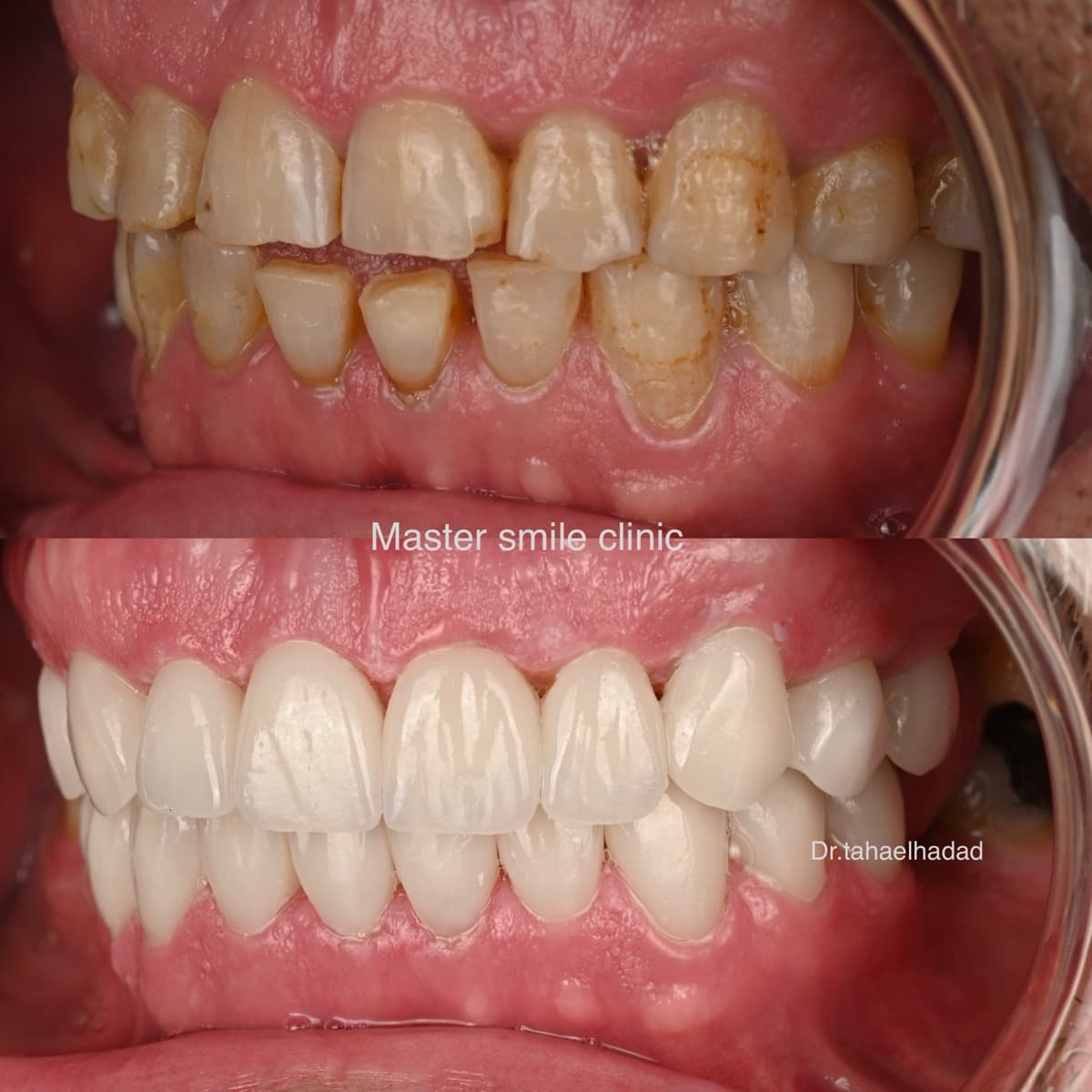 Resultat esthetique dentaire avant et apres, facettes ceramiques realisees a Casablanca par Dr. Taha El Hadad