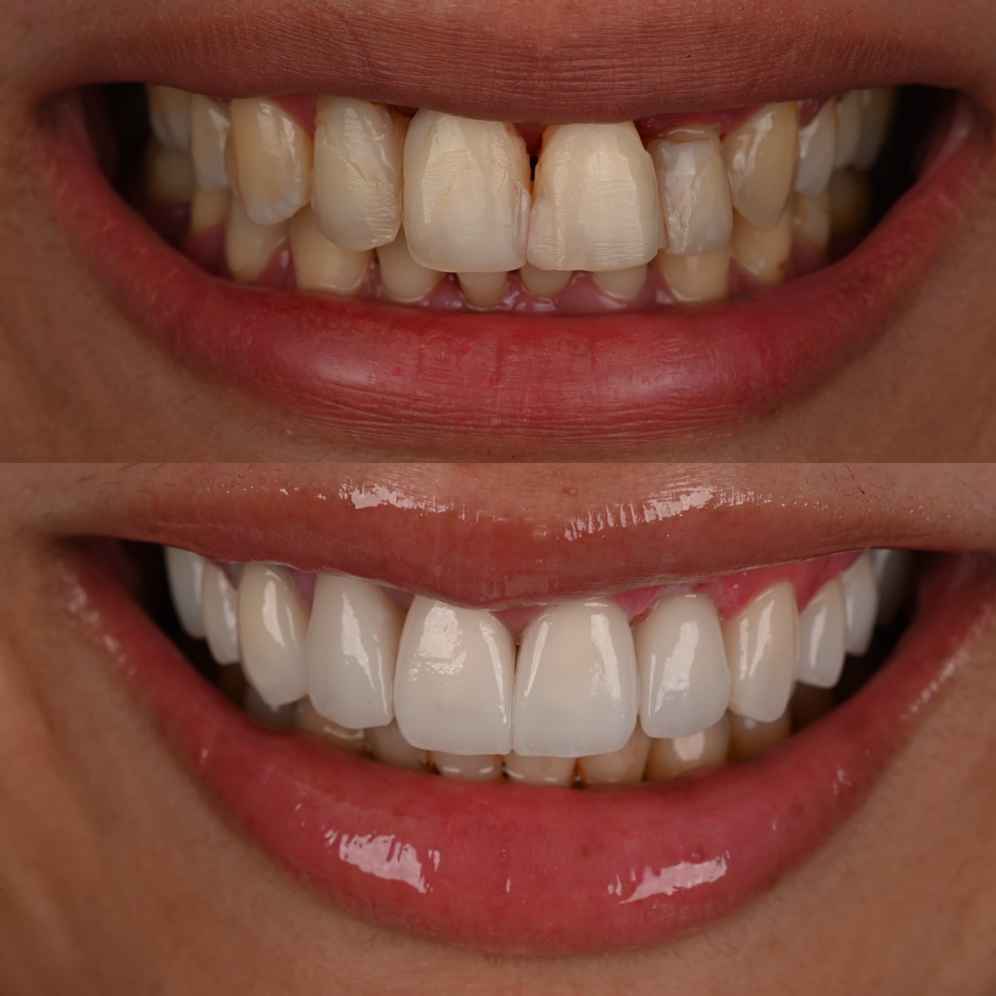 Resultat implant dentaire avant et apres a Casablanca par Dr. Taha El Hadad