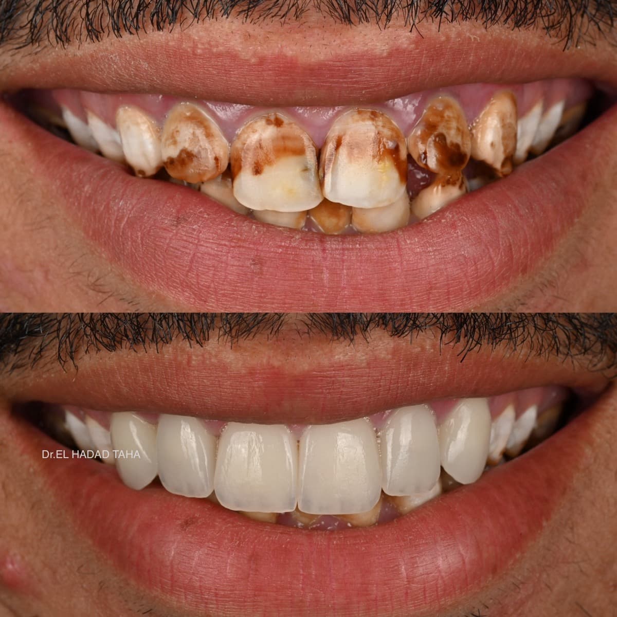 Resultat Invisalign avant et apres, gouttiere transparente pour alignement des dents a Casablanca