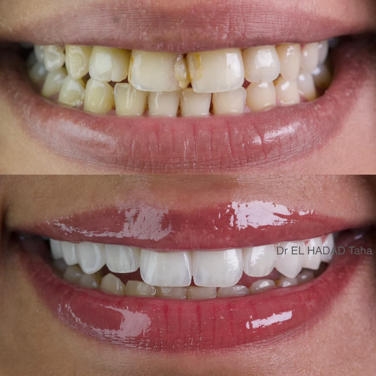 Invisalign a Casablanca, resultat avant et apres traitement d'alignement invisible chez Master Smile Clinic