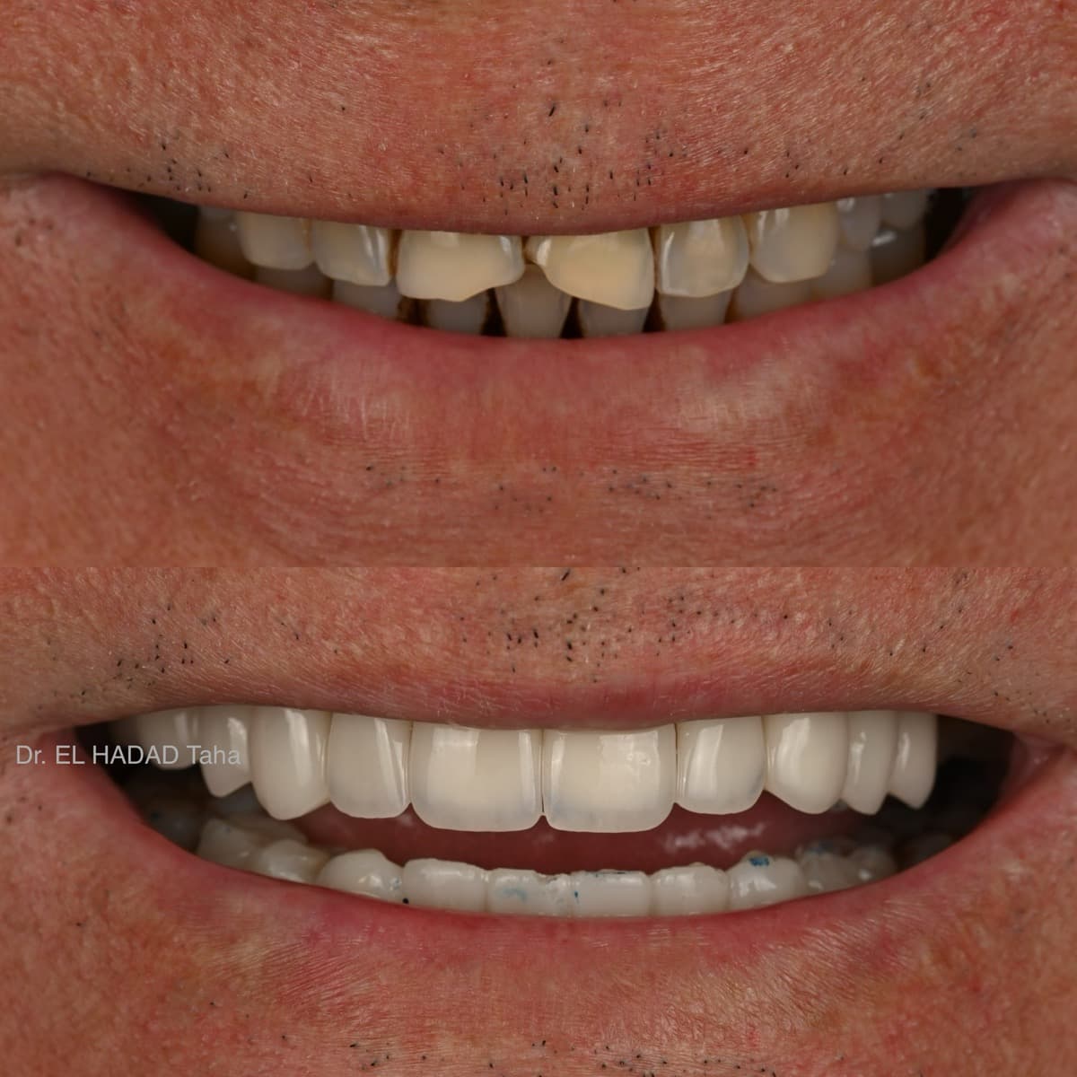 Traitement orthodontique avant et apres, alignement dentaire realise a Casablanca par Dr. Taha El Hadad