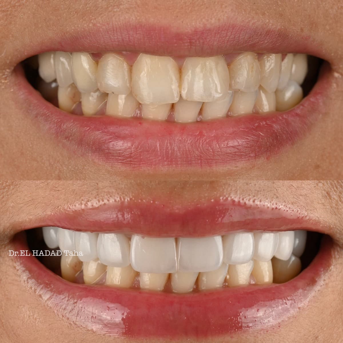 Resultat orthodontie avant et apres, correction de l'alignement des dents a Casablanca