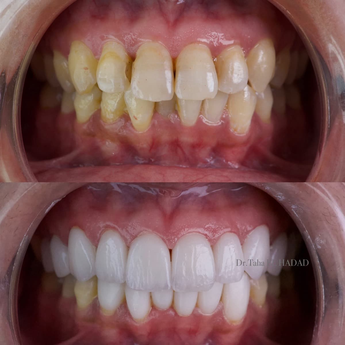 Orthodontiste a Casablanca, resultat avant et apres traitement d'alignement dentaire chez Master Smile Clinic