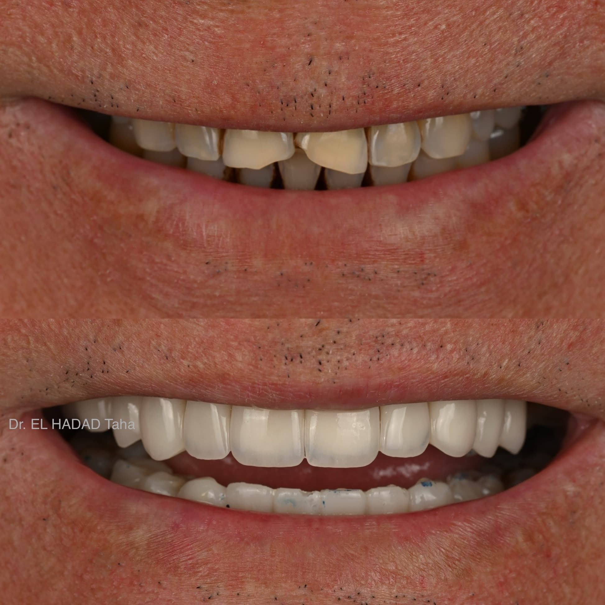 Traitement parodontal avant et apres, resultat realise a Casablanca par Master Smile Clinic