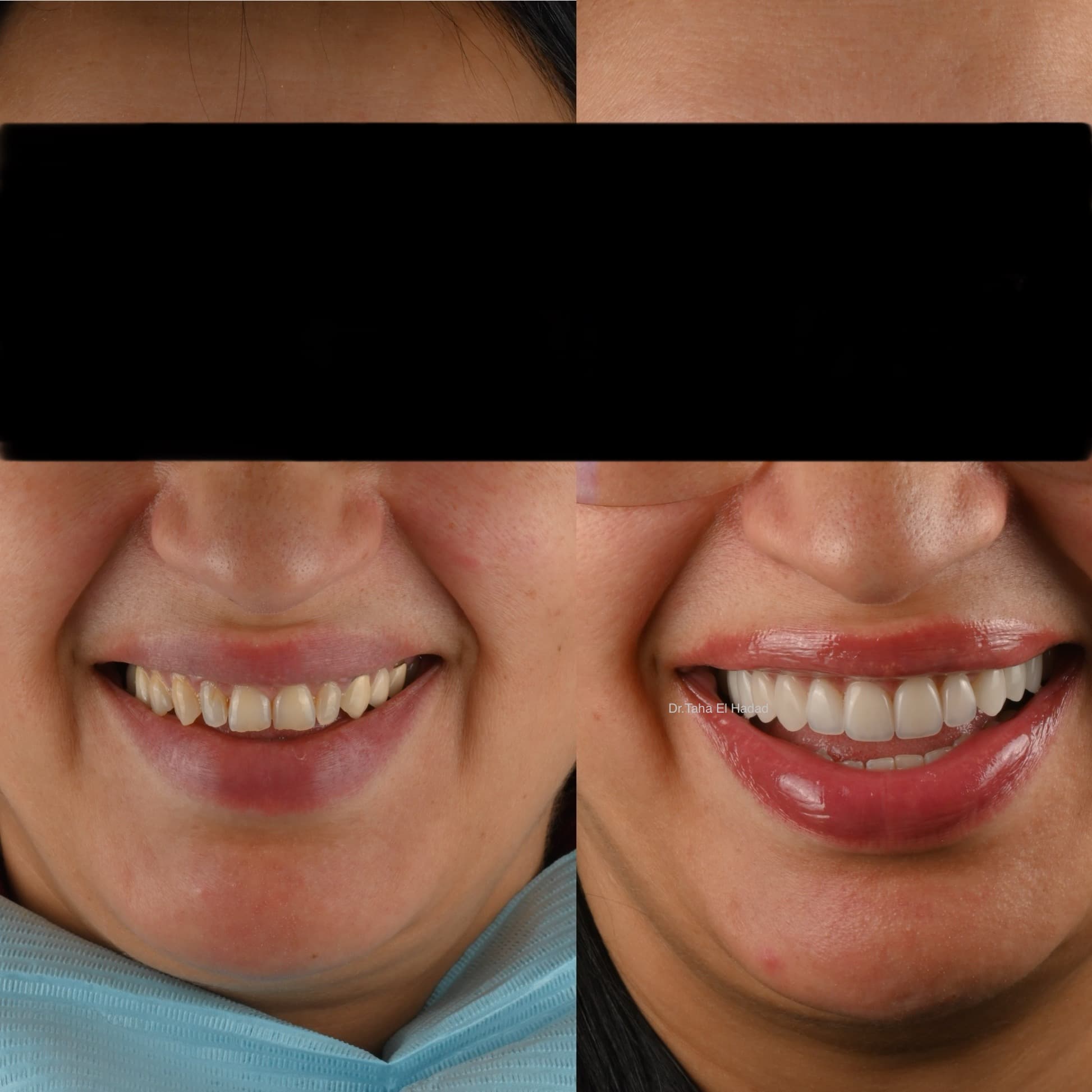 Resultat parodontologie avant et apres a Casablanca par Dr. Taha El Hadad