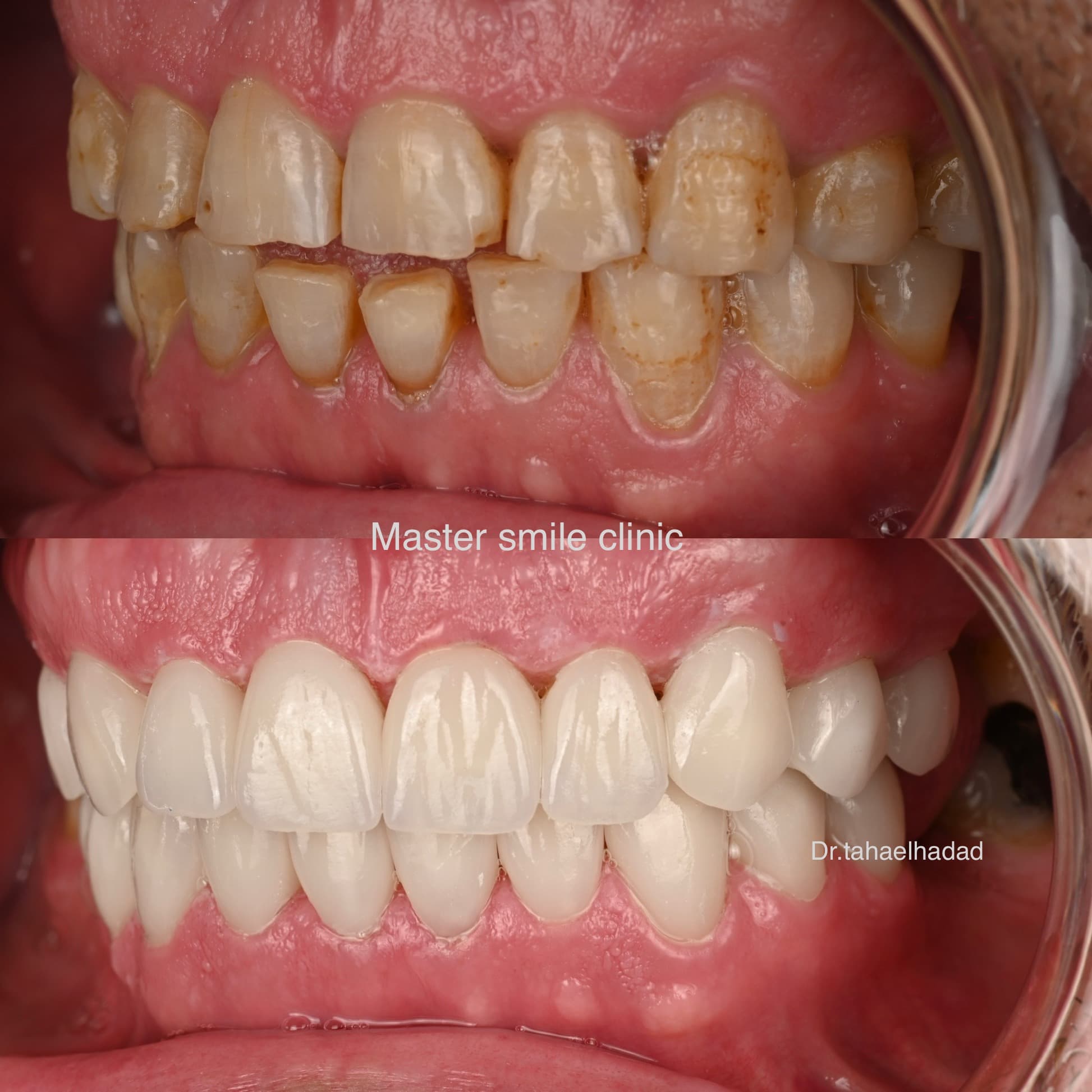 Prothese dentaire avant et apres, resultat realise a Casablanca par Master Smile Clinic