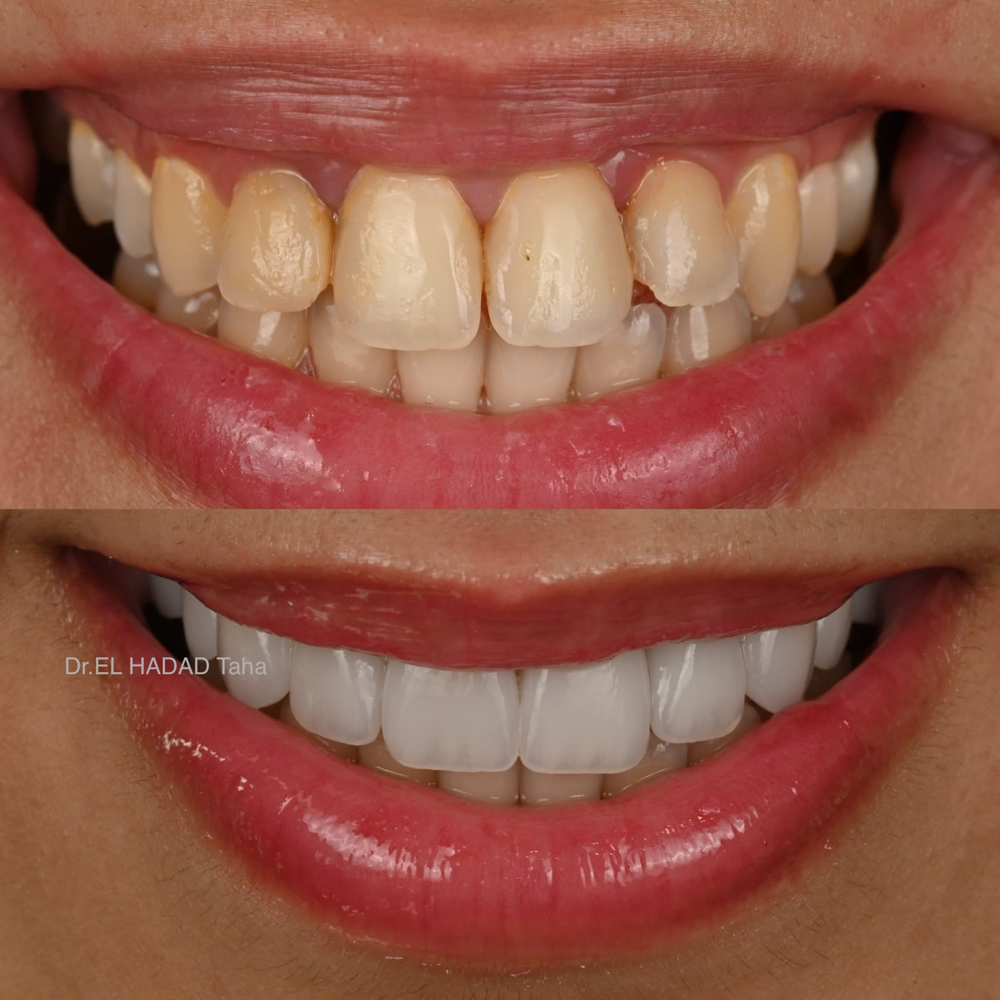 Prothese dentaire sur mesure resultat avant apres a la clinique Master Smile Clinic Casablanca