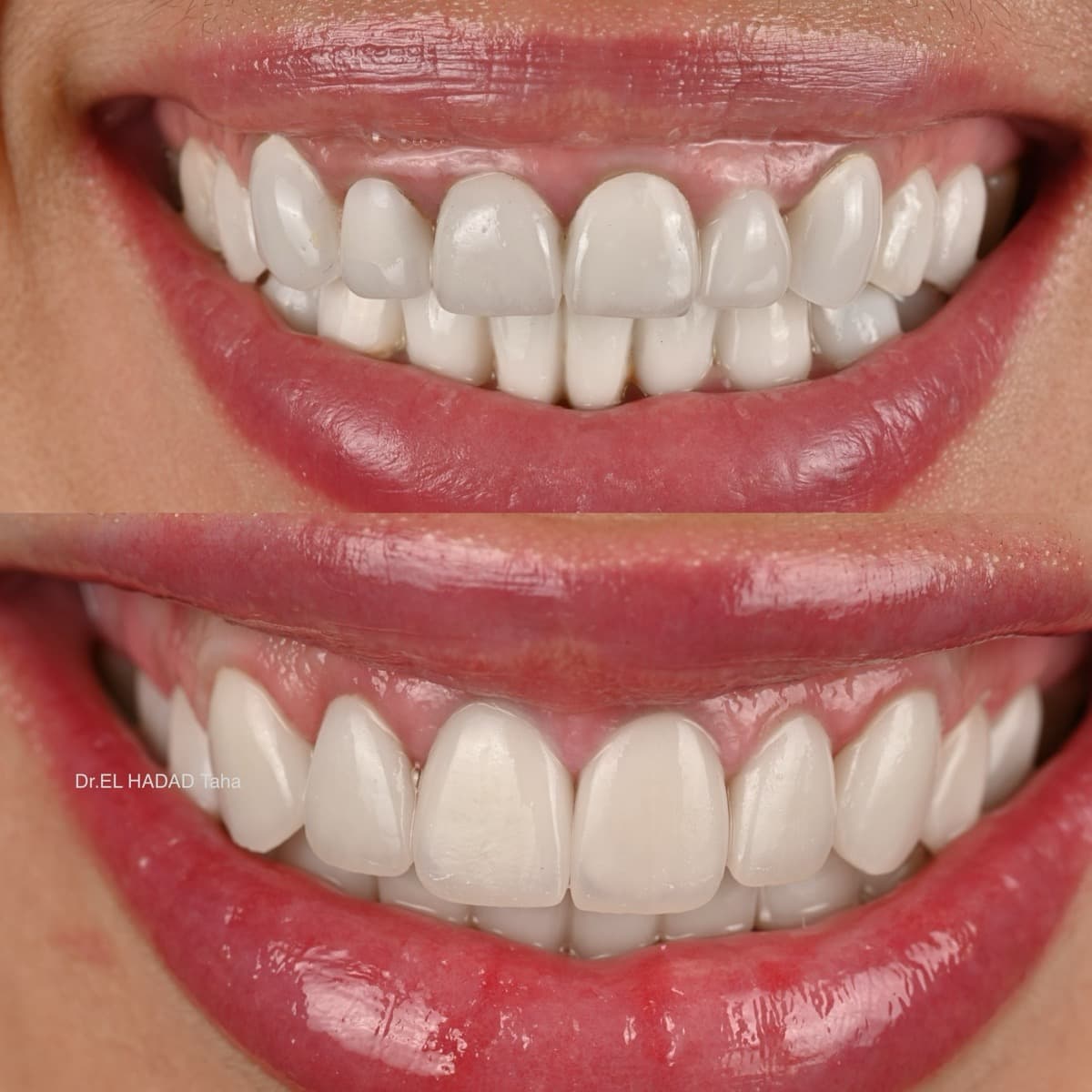 Soins dentaires avant et apres, traitement realise a Casablanca par Master Smile Clinic