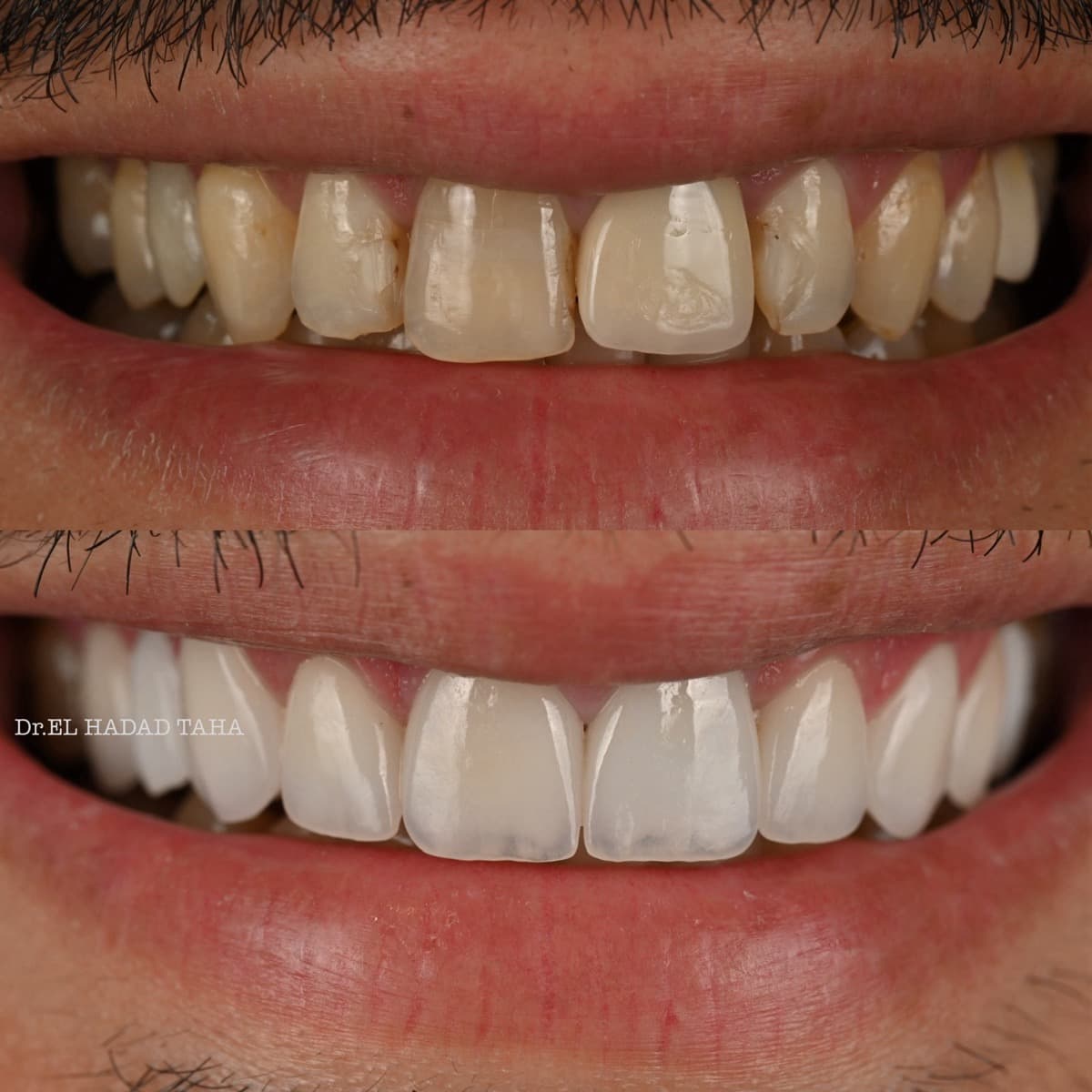 Soins et restauration dentaire avant et apres a la clinique dentaire Master Smile Clinic Casablanca