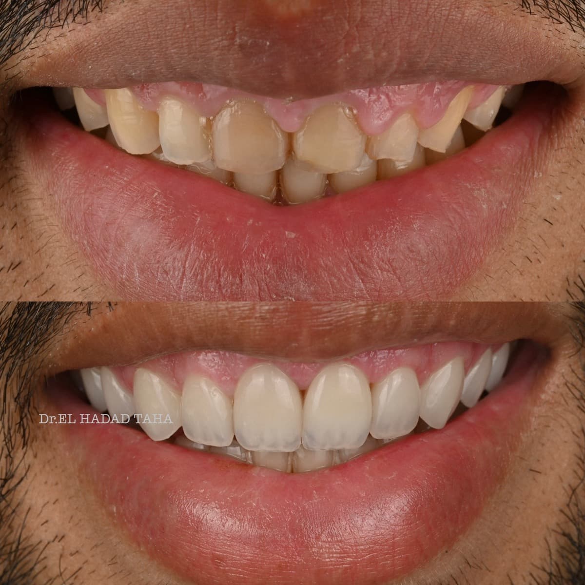 Resultat soins dentaires avant et apres, dentiste a Casablanca Dr. Taha El Hadad
